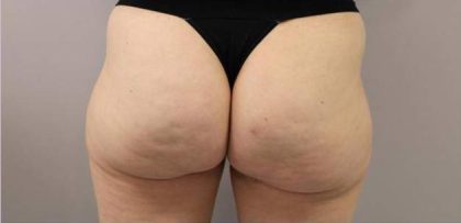 Body Contouring Before & After Patient #16485