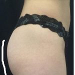 Body Contouring Before & After Patient #16387