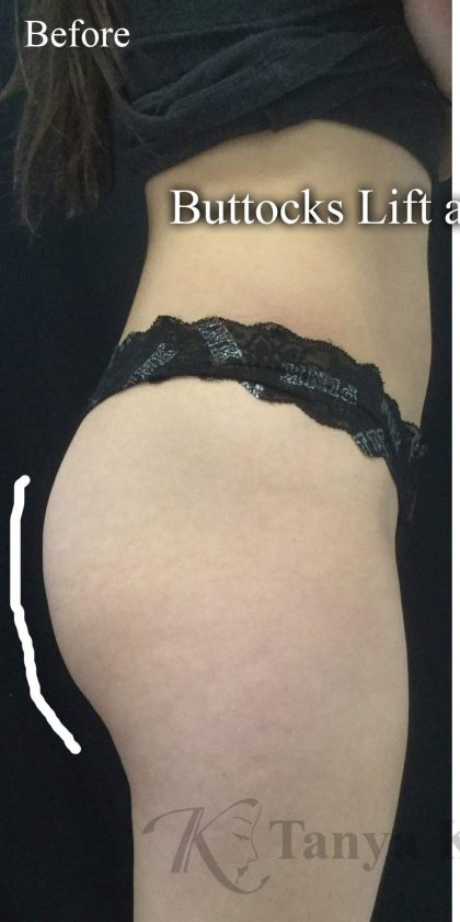Body Contouring Before & After Patient #16387