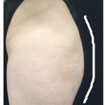 Body Contouring Before & After Patient #16388