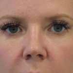 Facial Rejuvenation Before & After Patient #16183