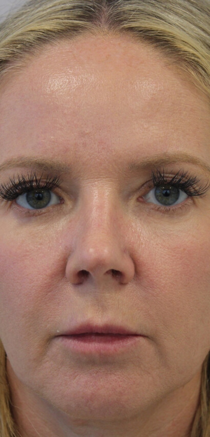 Facial Rejuvenation Before & After Patient #16183