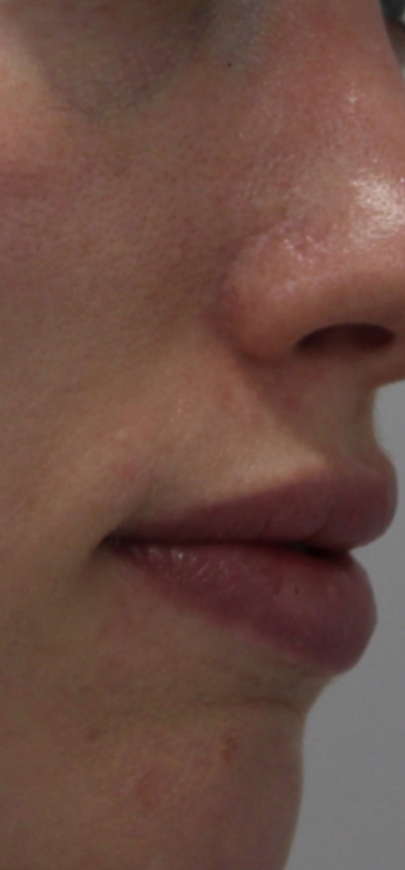 Facial Rejuvenation Before & After Patient #16189