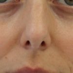 Facial Rejuvenation Before & After Patient #16192
