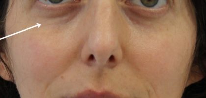 Facial Rejuvenation Before & After Patient #16192