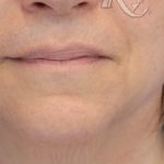 Facial Rejuvenation Before & After Patient #16195