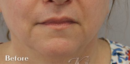 Facial Rejuvenation Before & After Patient #16195
