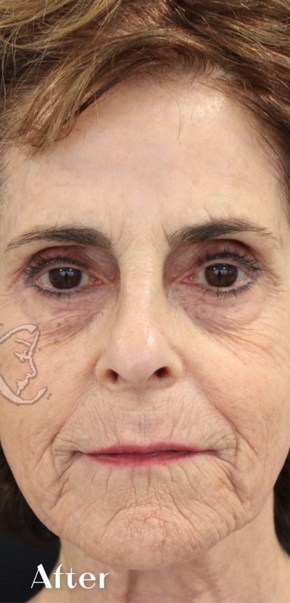 Facial Rejuvenation Before & After Patient #16198