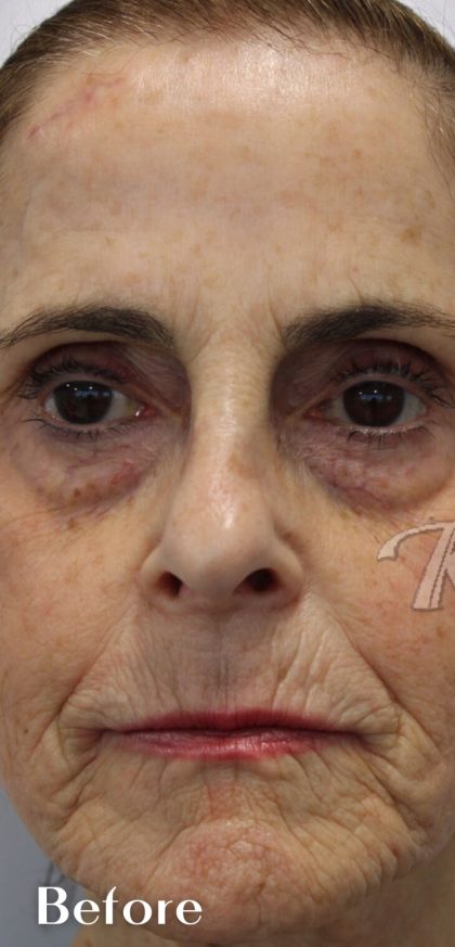 Facial Rejuvenation Before & After Patient #16198