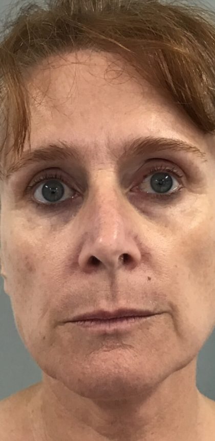 Facial Rejuvenation Before & After Patient #16212