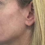 Facial Rejuvenation Before & After Patient #16391