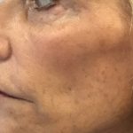 Facial Rejuvenation Before & After Patient #16392