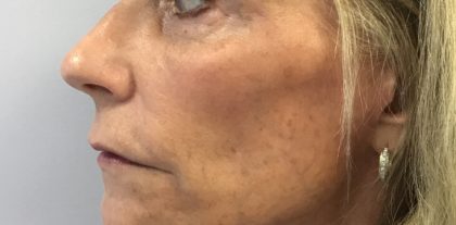 Facial Rejuvenation Before & After Patient #16392