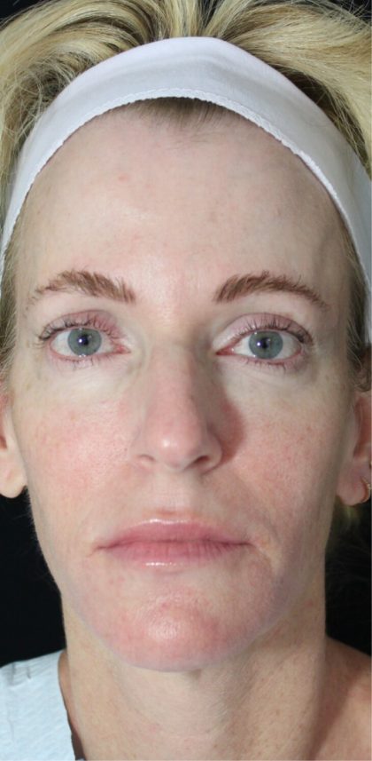 Facial Rejuvenation Before & After Patient #16413