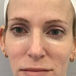 Facial Rejuvenation Before & After Patient #16413