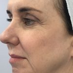 Facial Rejuvenation Before & After Patient #16414