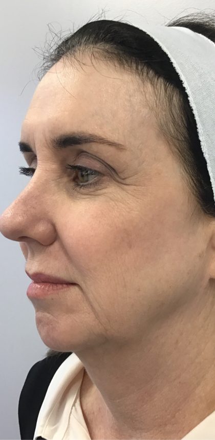 Facial Rejuvenation Before & After Patient #16414