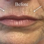 Facial Rejuvenation Before & After Patient #16459