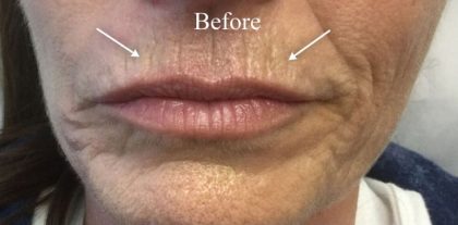 Facial Rejuvenation Before & After Patient #16459