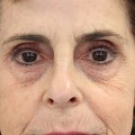 Facial Rejuvenation Before & After Patient #16460