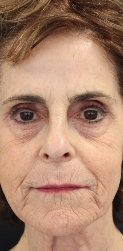 Facial Rejuvenation Before & After Patient #16460