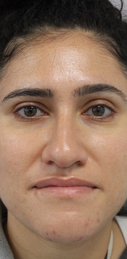 Facial Rejuvenation Before & After Patient #16461