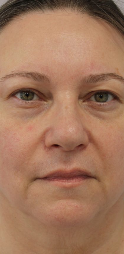 Facial Rejuvenation Before & After Patient #16497