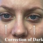 Facial Rejuvenation Before & After Patient #16498