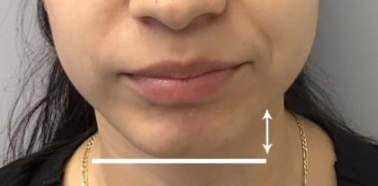 Facial Rejuvenation Before & After Patient #16502