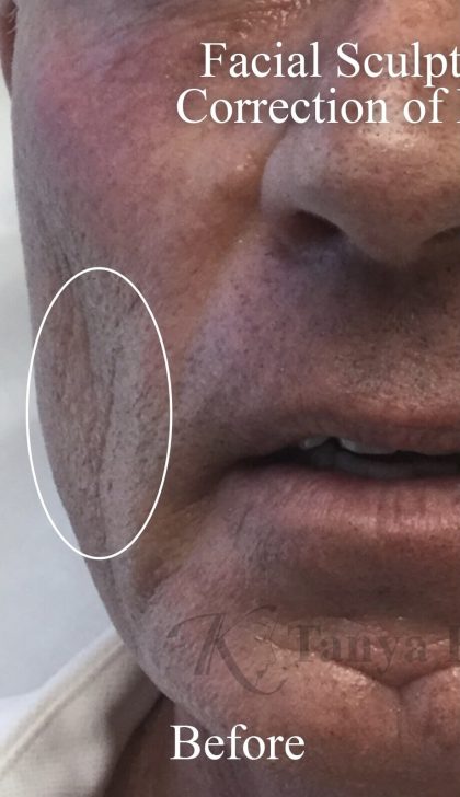 Facial Rejuvenation Before & After Patient #16518