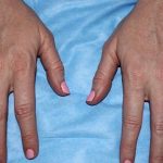 Hand Rejuvenation Before & After Patient #16210