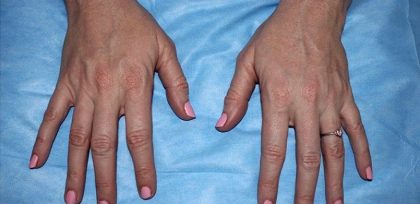 Hand Rejuvenation Before & After Patient #16210