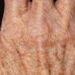 Hand Rejuvenation Before & After Patient #16214