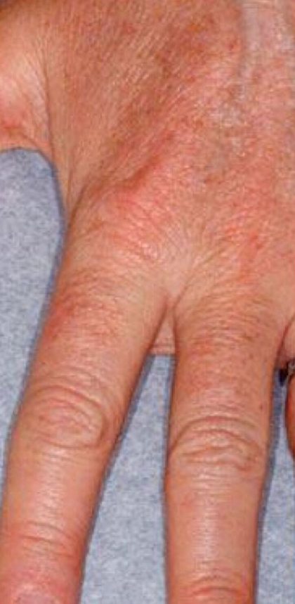 Hand Rejuvenation Before & After Patient #16221