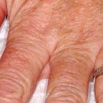 Hand Rejuvenation Before & After Patient #16221