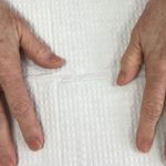 Hand Rejuvenation Before & After Patient #16252