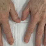 Hand Rejuvenation Before & After Patient #16252