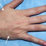 Hand Rejuvenation Before & After Patient #16304