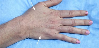 Hand Rejuvenation Before & After Patient #16304