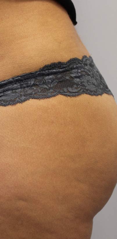 Cellulite & Stretchmarks Before & After Patient #16548