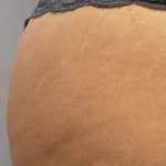 Cellulite & Stretchmarks Before & After Patient #16548