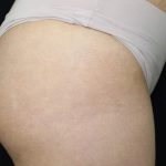 Cellulite & Stretchmarks Before & After Patient #16549