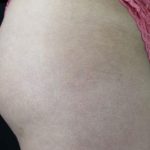 Cellulite & Stretchmarks Before & After Patient #16549