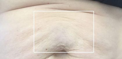 Cellulite & Stretchmarks Before & After Patient #16551