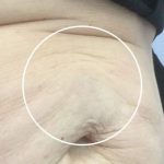 Cellulite & Stretchmarks Before & After Patient #16552