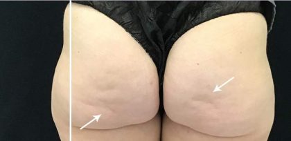 Cellulite & Stretchmarks Before & After Patient #16553