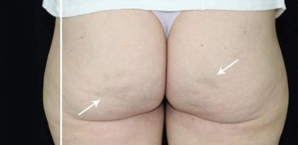 Cellulite & Stretchmarks Before & After Patient #16553