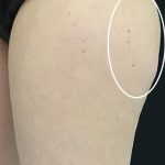 Cellulite & Stretchmarks Before & After Patient #16554