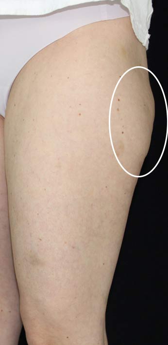 Cellulite & Stretchmarks Before & After Patient #16554