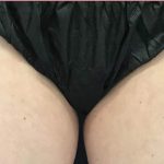 Cellulite & Stretchmarks Before & After Patient #16555